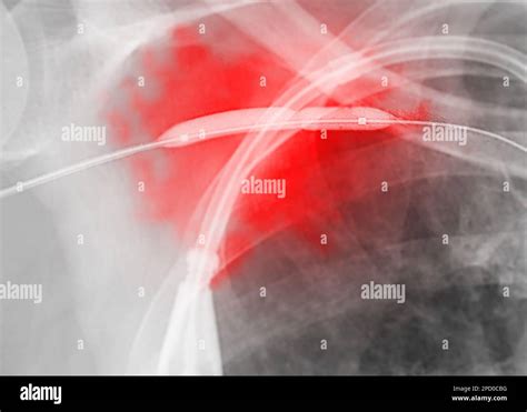 Image Of Angioplasty Balloon Angioplasty And Percutaneous Transluminal