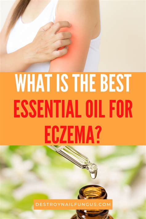 Top 8 Eczema Essential Oils To Heal And Soothe The Skin