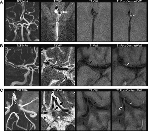 Multicontrast High Resolution Vessel Wall Magnetic Resonance Imaging