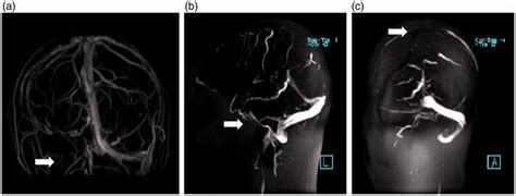 Brain Magnetic Resonance Venography Mrv Revealed Right Transverse