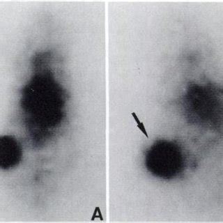 Biodistribution Data For 0 5 IiCi Labeled MoAb 17 1A In Athymic Nude