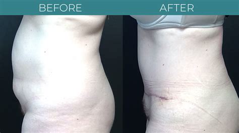 Tummy Tuck Sterling Virginia Berman Cosmetic Surgery