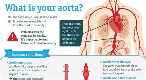 Infographic Conditions That Cause Aortic Disease Doctors Without Waiting Rooms