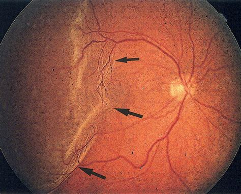 Retinal Detachment Imaging Of Surgical Treatments And Complications Radiographics