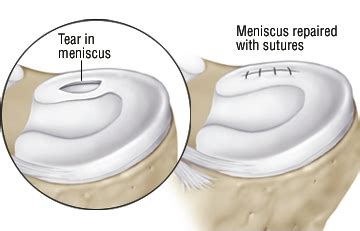 Meniscus Arthroscopy Surgery The Orthopedic Center Of Puerto Vallarta