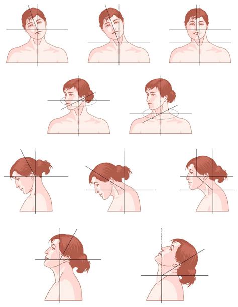 Torticollis Diagram