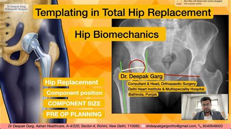 Mastering Pre Operative Templating In Total Hip Replacement Surgery