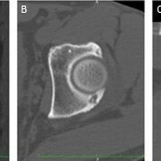 Coronal A Axial B And Sagittal C Ct Images Showing An