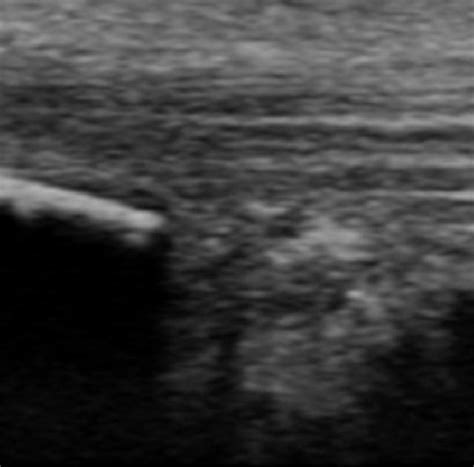 Ultrasound Image Of Minor Haglund Deformity With Sharp Edge Enlarged Download Scientific