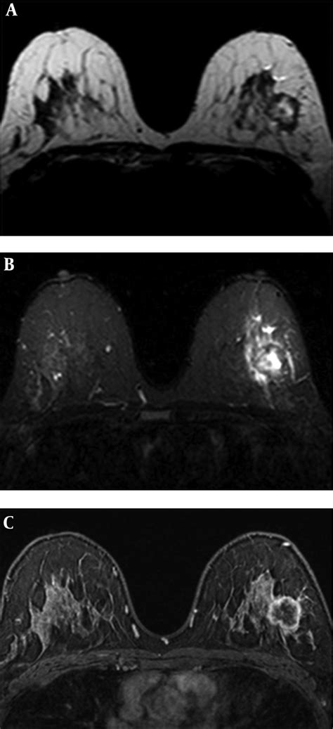 triple negative breast cancer invasive ductal carcinoma   left