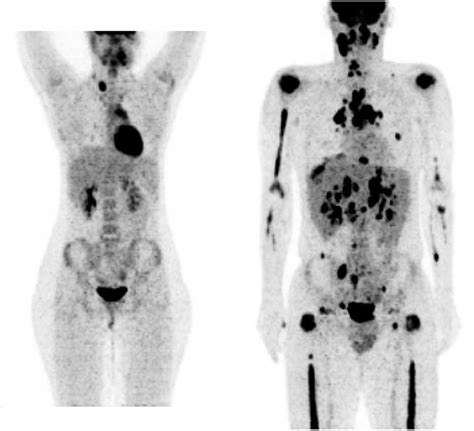 Interim FDG PET CT For Therapy Monitoring And