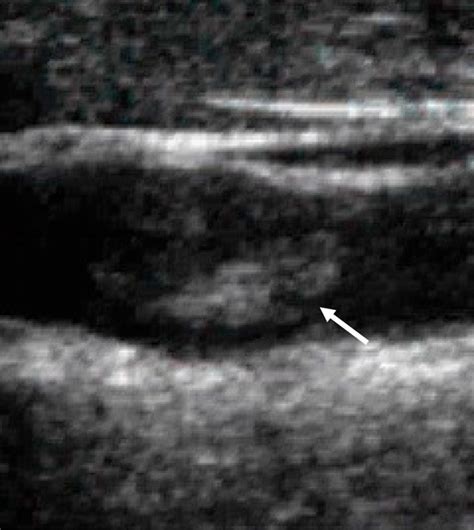 Carotid Duplex Sonography Performed On 1 October 2003 The Floating