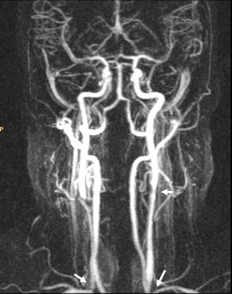 Multiple Stenoses In The Carotid And Vertebral Branches Arrows In A