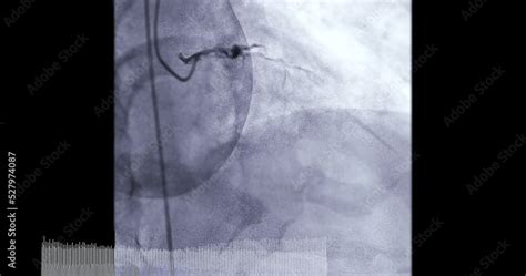 Video „coronary Angiogram Of Coronary Artery During Cardiac