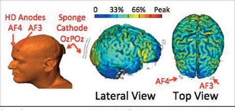 Figure 1 From A Feasibility Study Of Bilateral Anodal Stimulation Of