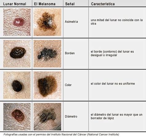 Que Saber Sobre Los Lunares Blog De Farmacia