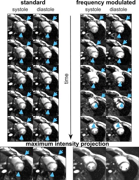 Real Time Cine Imaging A Short Axis View Of The Human Heart Is Given