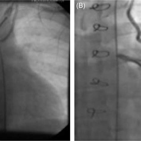 (A) Angiographic image of left internal mammary artery (LIMA) to right ...