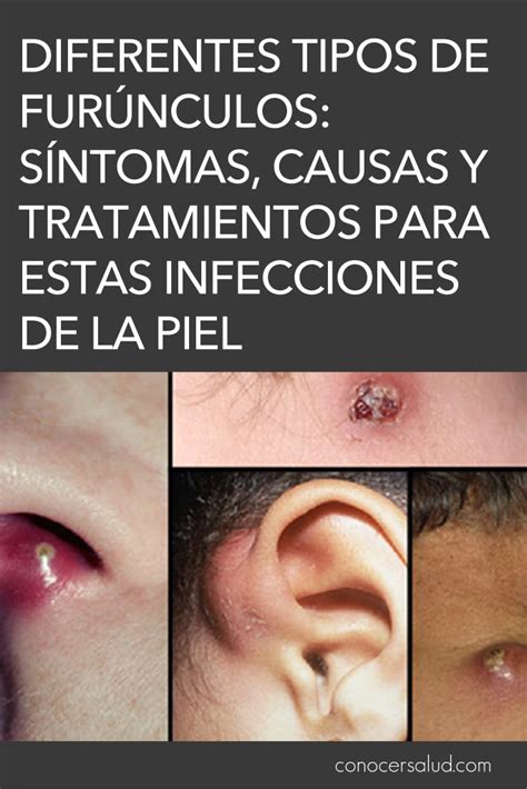 Diferentes Tipos De Fur Nculos S Ntomas Causas Y Tratamientos Para