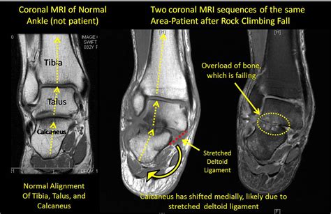 Ankle Spain Diagnosis - Tyler, TX | Podiatrist