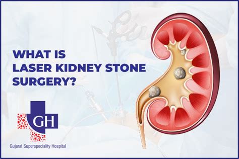 What Is Laser Kidney Stone Surgery?