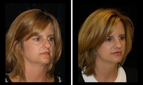 Mini Facelift Results On A Middle Aged Female Patient Aesthetica Cosmetic Surgery And Laser Center