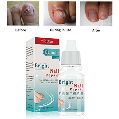 Buy Yiwa Nail Fungus Cream Onychomycosis Paronychia Anti Fungal Nail