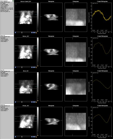 Positive Nuclear Medicine Cardiac Stress Test Image