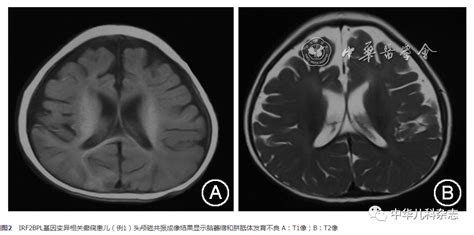 【临床研究与实践】irf2bpl基因变异相关的癫痫患儿临床表型特点delg