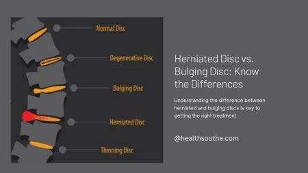 Herniated Disc Vs. Bulging Disc: Know The Differences