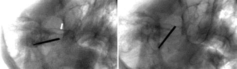 Placement Of Needle In The Foramen The Neurosurgical Atlas