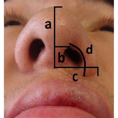 Patient With Secondary Unilateral Cleft Lip Nose Deformity And Nose