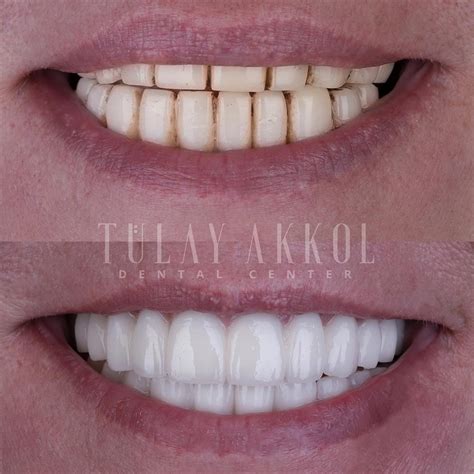 All On Six Dental Implants Restore Your Smile Today Akkoldental