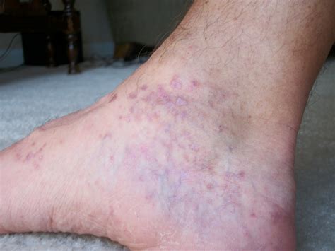 What Causes A Rash On My Feet