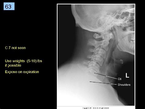 1 Cervical Spine Rtec 124 Week 6 Rev