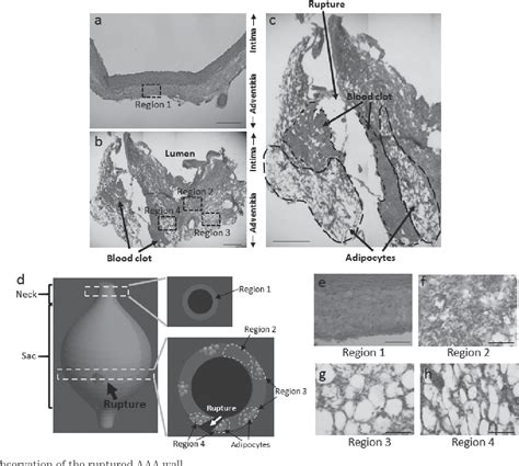 Figure 1 From Pathological Analysis Of The Ruptured Vascular Wall Of