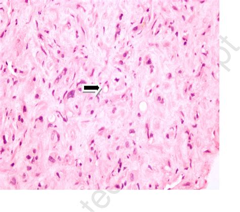 Figure 1 From Malignant Hepatic Epithelioid Hemangioendothelioma With