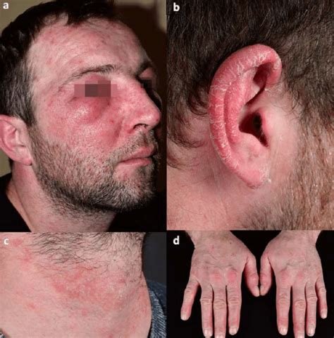 Allergic Contact Dermatitis Treatment