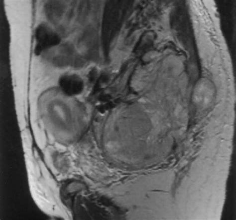 Mr Imaging Of Common And Uncommon Large Pelvic Masses Radiographics