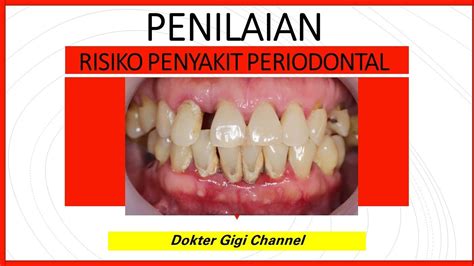 Periodontal Risk Assesment Penilaian Risiko Penyakit Periodontal