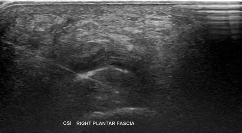 Plantar Wart Ultrasound