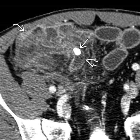 Appendicitis Radiology Key