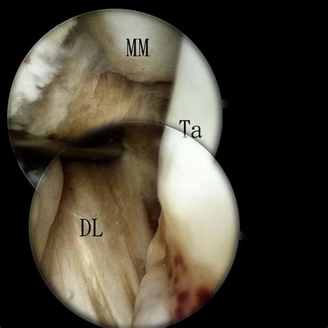 Arthroscopically Assisted Reduction Of Sagittal Plane Disruption Of