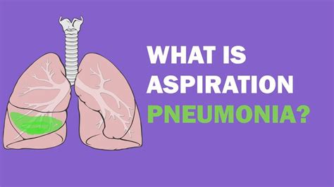 What Is Aspiration Pneumonia