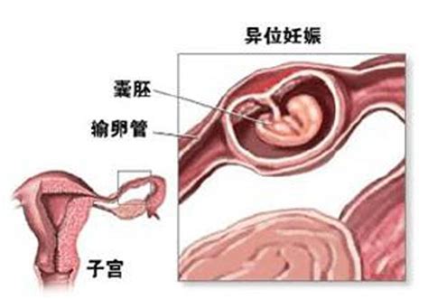 懷孕6個月子宮是空的？醫生檢查後都嚇壞了，這到底是為啥？ 每日頭條