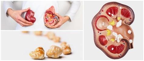 Cálculos Renales Causas Síntomas Signos Diagnóstico Tratamiento