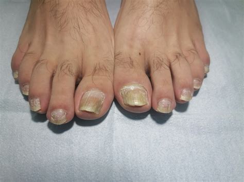 Tratamiento Onicomicosis Hongos en Uñas Perfectpie SPA