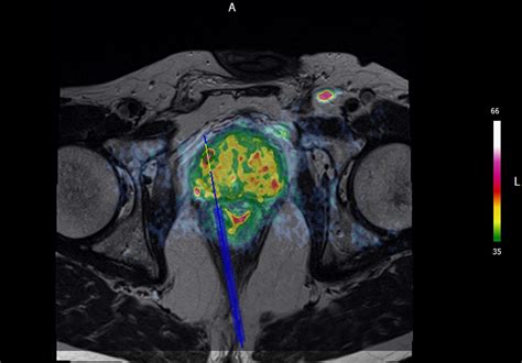 Image Guided Targeted Prostate Biopsies Techniques In Vascular