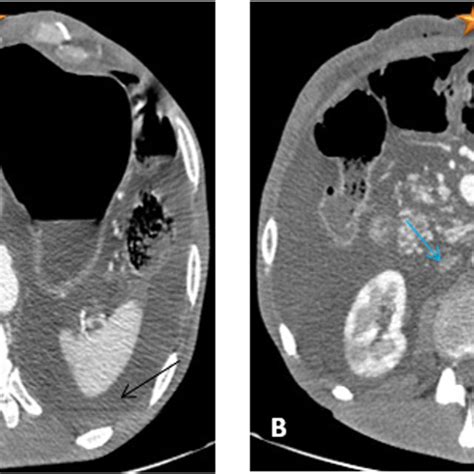 Contrast Enhanced Axial Ct Scans Of Acs Showing Distended Abdomen