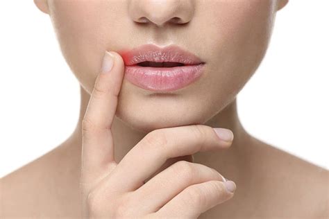 Herpes labial factores de riesgo y recurrencia Clínica Dental Suárez Solís